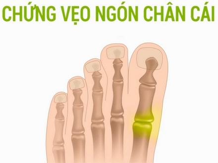 Cách ngăn ngừa chứng vẹo ngón chân cái