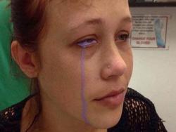 'Đú đởn' xăm nhãn cầu, cô gái trẻ khóc uất nghẹn vì biến chứng mù mắt