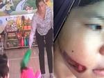 Bé gái 4 tuổi bị đa chấn thương toàn thân, nghi ngờ bị bạo hành ở trường mầm non-2