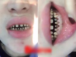 Cô gái bóc phốt cơ sở nha khoa bọc răng sứ 100 triệu sau 2 năm hư hỏng nặng