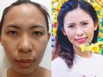 Chàng ca sĩ trẻ lột xác ngoạn mục sau ca phẫu thuật hàm móm-7