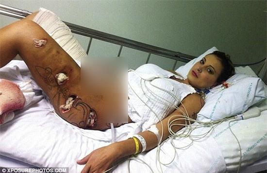 Nữ MC Brazil thủng chân, nguy cơ mất mạng vì độn vòng ba