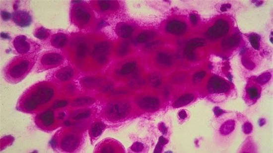 Kiểm tra HPV thay thế cho Pap để phát hiện ung thư cổ tử cung 1