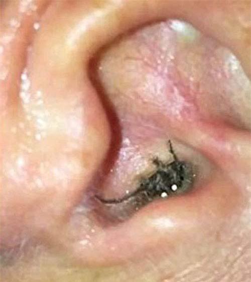 Hốt hoảng vì nhện làm tổ trong lỗ tai người - 1
