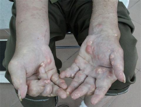 Bàn tay viêm sưng của người bệnh gout