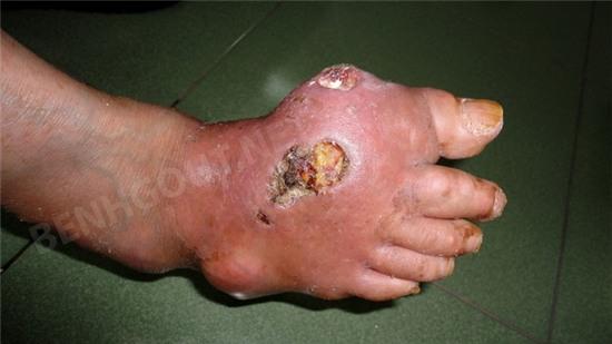 Bàn chân của người bệnh gout
