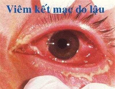 Viêm kết mạc mắt do bệnh lậu