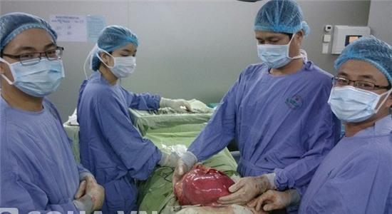 Khối u khổng lồ trong bụng nữ bệnh nhân vừa được lấy ra