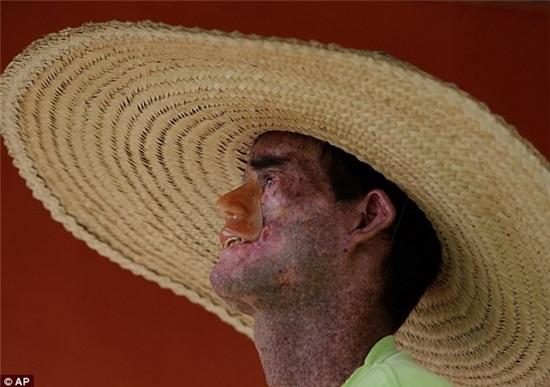 Bệnh lạ khiến cơ thể người thối rữa dưới nắng ở Brazil