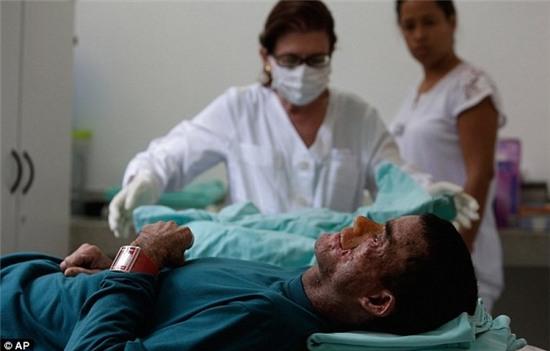 Bệnh lạ khiến cơ thể người thối rữa dưới nắng ở Brazil