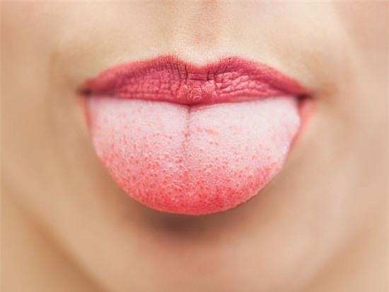  Nhận biết cơ thể có nhiễm độc tố hay không thông qua màu sắc lưỡi. Ảnh: Boldsky 