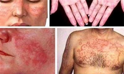  Một số tổn thương cơ thể do Lupus ban đỏ. Ảnh: SKĐS 