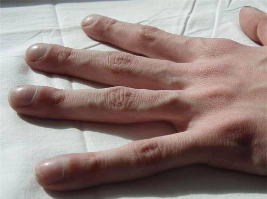 dấu hiệu bất thường ở móng tay