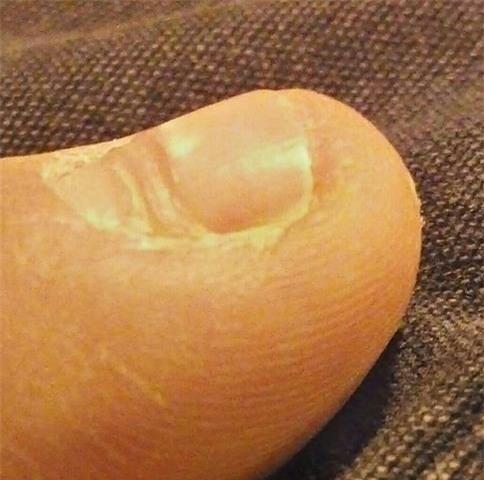 dấu hiệu bất thường ở móng tay