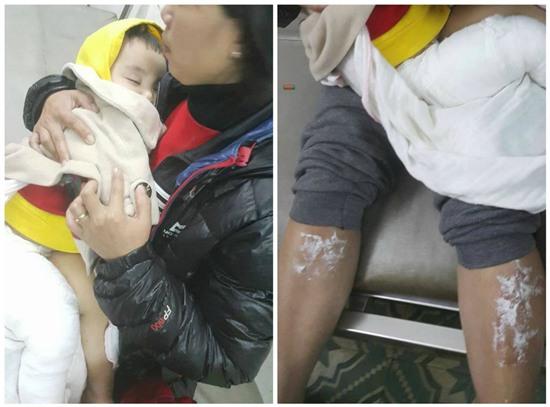 Nguy hiểm tính mạng khi sưởi ấm bằng túi chườm nóng