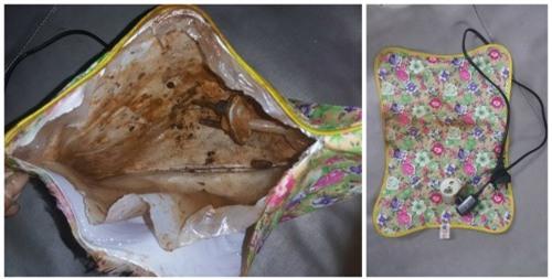 Nguy hiểm tính mạng khi sưởi ấm bằng túi chườm nóng