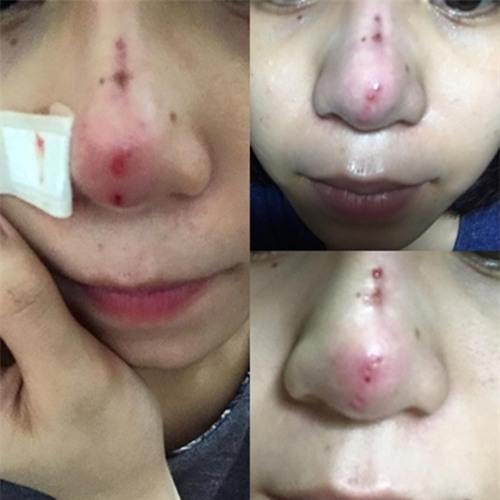 Một cô gái Sài Gòn chia sẻ trải nghiệm khủng khiếp sau khi nâng mũi bằng chỉ - Ảnh 3.