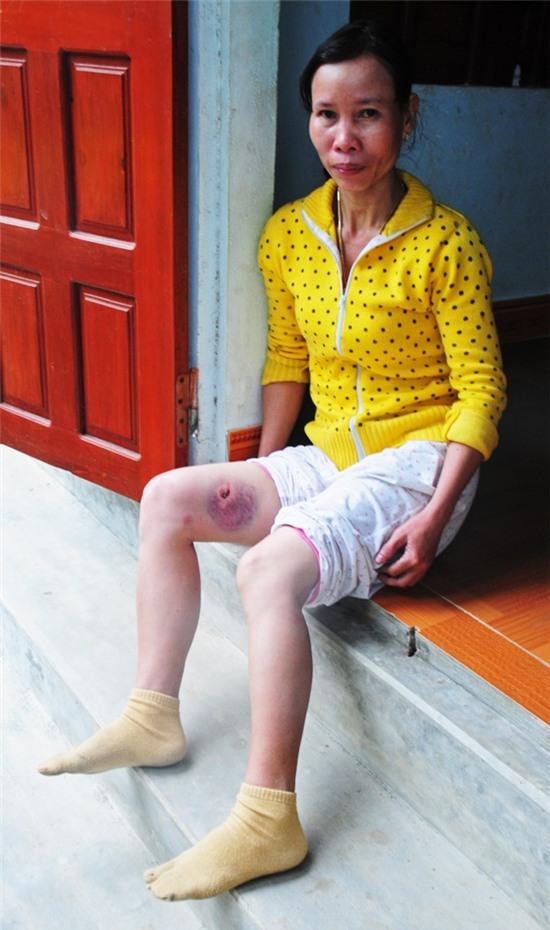 Xem pháo hoa đêm giao thừa, nhiều người nhập viện