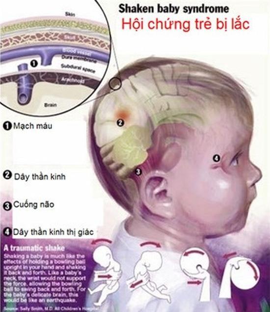 Việc rung, lắc trẻ sẽ gây ra những hậu quả khôn lường.