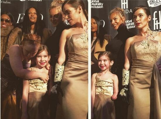 người mẫu nhí cụt tay