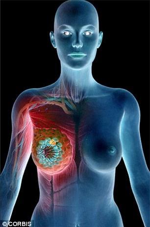 loại bỏ ung thư vú