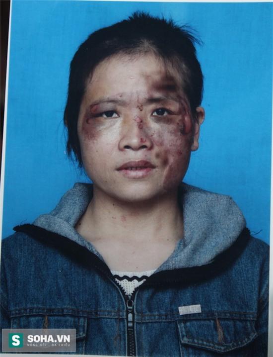 Anh ấy cầm chiếc tô inox đã nung đỏ rồi lao đến áp vào má tôi - Ảnh 1.