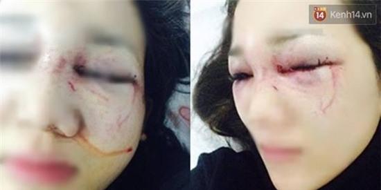 Yêu nhau 3 tháng, cô gái Hải Phòng bị người yêu đánh đến biến dạng mặt - Ảnh 1.