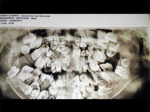 soc: be trai 9 tuoi moc gan 300 chiec rang trong mieng hinh anh 1