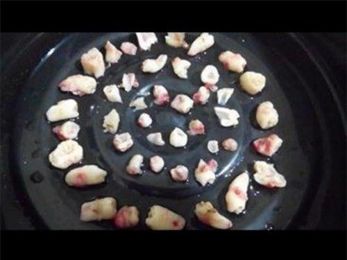 soc: be trai 9 tuoi moc gan 300 chiec rang trong mieng hinh anh 3