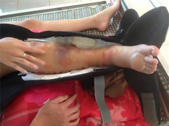 Nước mắt âu lo của người mẹ về tương lai của nữ sinh lớp 10 bị cưa chân - Ảnh 1.