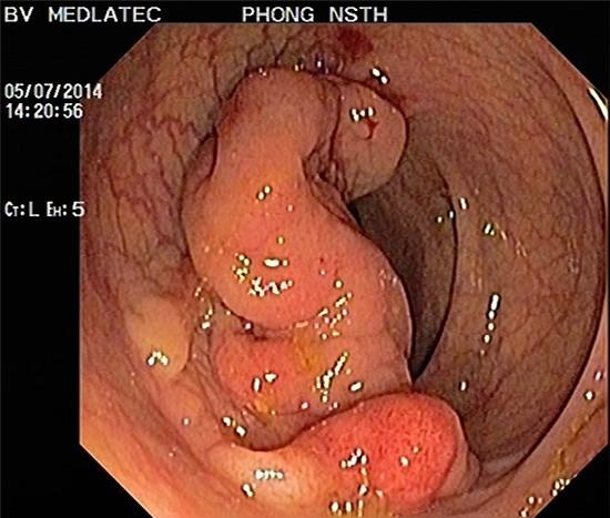 Ung thư đại trực tràng