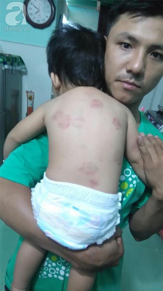 Vụ trẻ bị cắn ở trường mầm non: Nhà trường nói