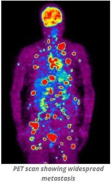 Hình ảnh chụp PET Scan của bệnh nhân ung thư giai đoạn di căn (Ảnh lấy từ diễn đàn chia sẻ phương pháp dinh dưỡng Keto phòng chống ung thư) 