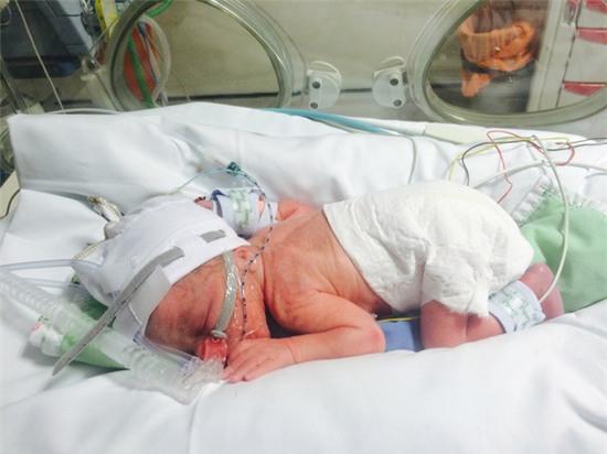 ca sinh mổ hi hữu