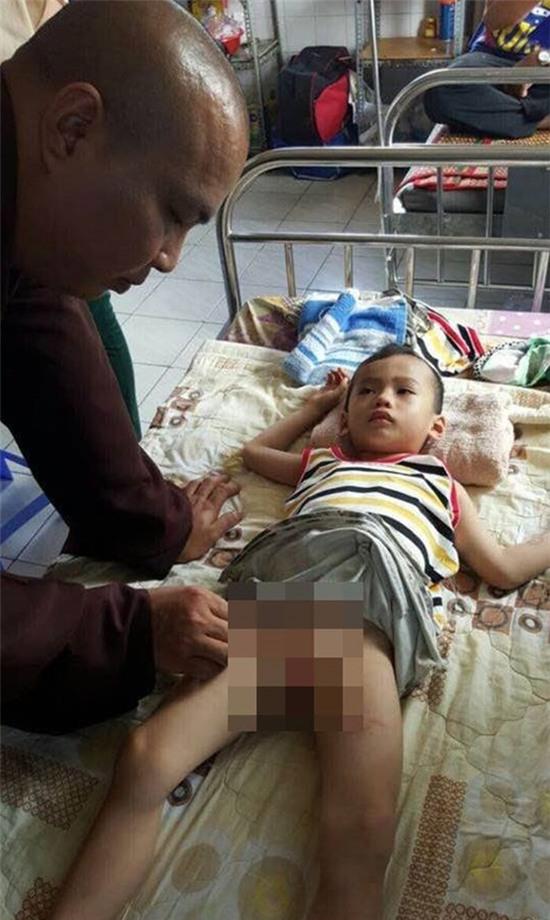 Bé 4 tuổi bị bỏng ở nhóm trẻ gia đình