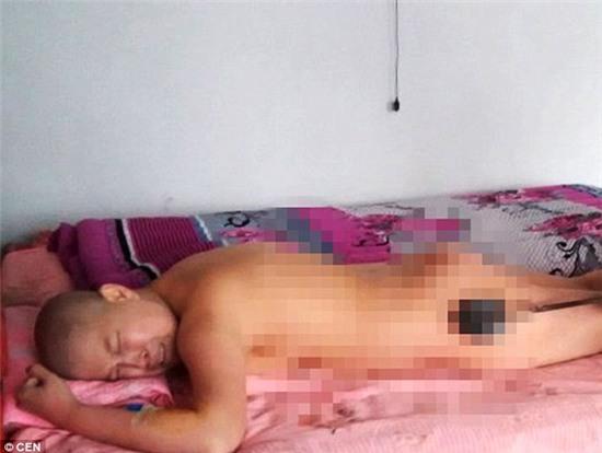 Không có tiền chữa bệnh, người phụ nữ bị chẩn đoán mắc bệnh ung thư tin rằng sắt nóng có thể làm chết các tế bào gây bệnh.