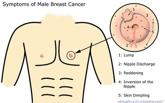 bệnh ung thư ở nam giới