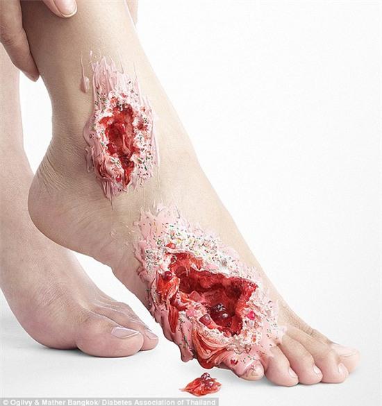 biến chứng của bệnh tiểu đường