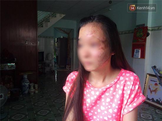 6 tháng sau khi vụ tạt axit hủy hoại khuôn mặt, nữ sinh Sài Gòn chỉ biết giam mình trong bóng tối - Ảnh 3.
