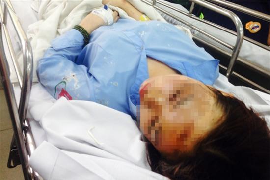 Nạn nhân Hương bị bỏng gần hết mặt, có nguy cơ mù hai mắt.