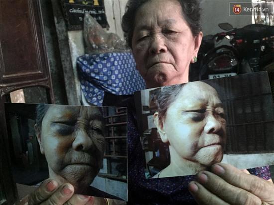 TP. HCM: Khuyên các con đừng cãi nhau, cụ bà bị đánh gãy xương hốc mắt - Ảnh 1.