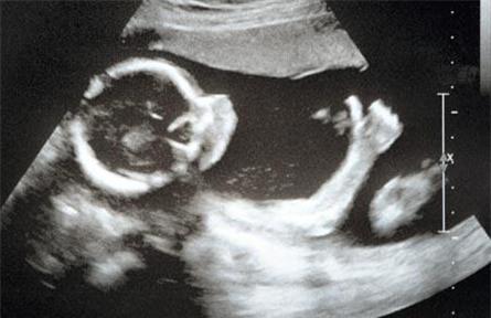 Siêm âm đo chu vi vòng đầu định kỳ sẽ đánh giá được sự phát triển của đầu có bình thường hay bất thường.