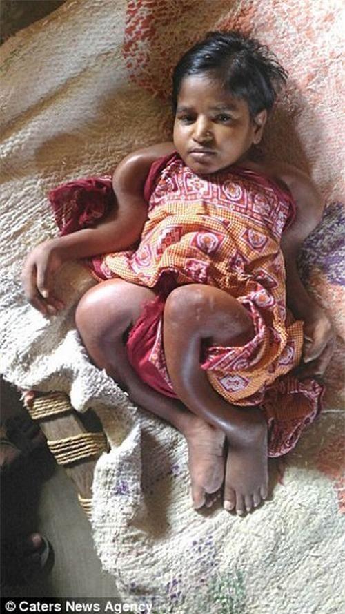 co gai 25 tuoi bi teo nho co the nhu be so sinh hinh anh 1