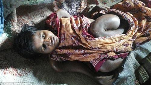 co gai 25 tuoi bi teo nho co the nhu be so sinh hinh anh 2