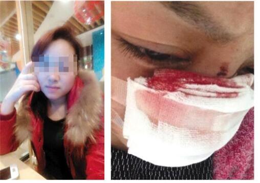 Cô Li tiết lộ mình bị chồng cắt mũi và bạo hành nhiều lần. Ảnh: Weibo
