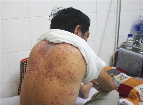 Hiện, các nốt ban đang mờ dần, bệnh nhân hết sốt, đã ăn được sau 4 ngày điều trị tại bệnh viện.