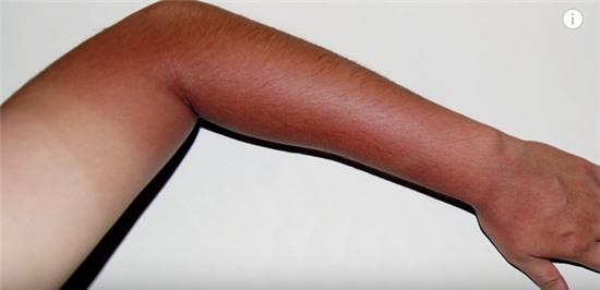 Điều gì thực sự đã xảy ra khi chúng ta bị cháy nắng? - Ảnh 3.