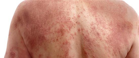 Điều gì thực sự đã xảy ra khi chúng ta bị cháy nắng? - Ảnh 5.