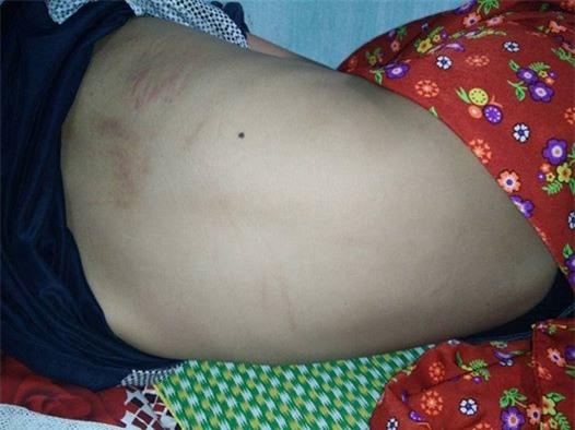 Vết mèo cào trên lưng bệnh nhi H.V.H.