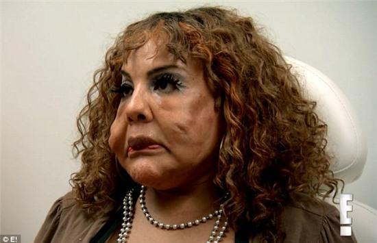 Sự đau đớn của người phụ nữ chuyển giới được phẫu thuật bơm xi măng và keo cầu vào mặt - Ảnh 1.